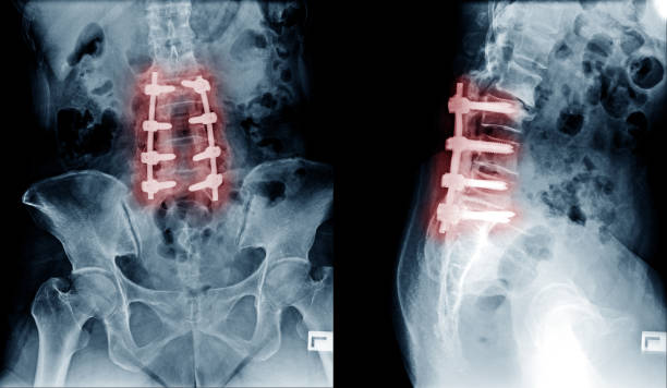 cervical and lumbar spondylosis